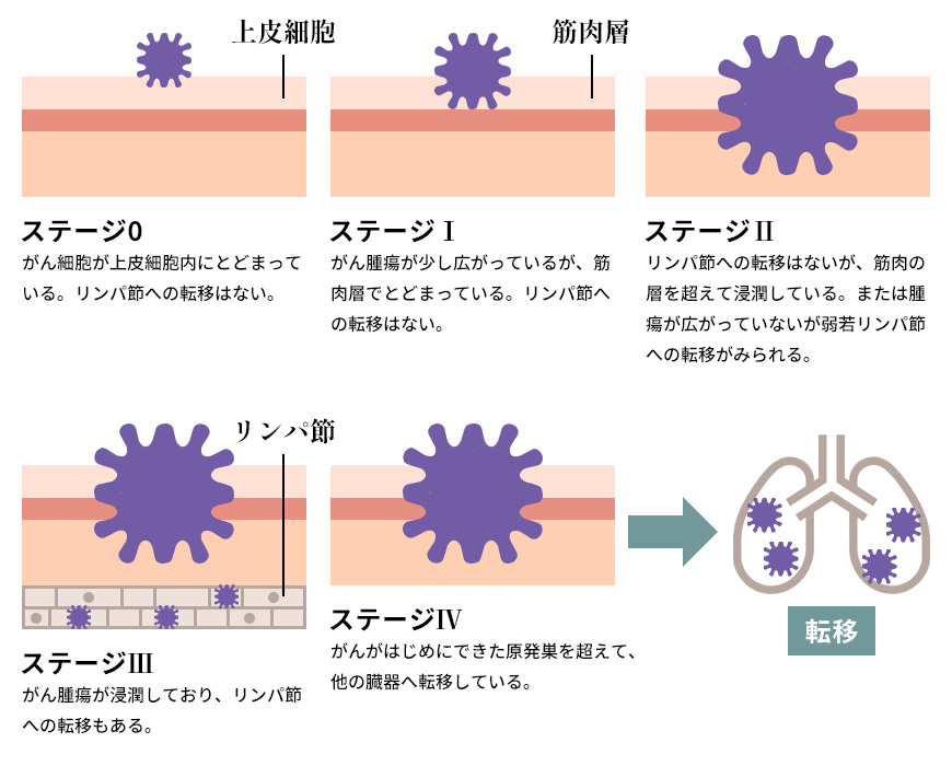 癌のステージ