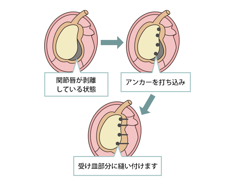 関節鏡手術