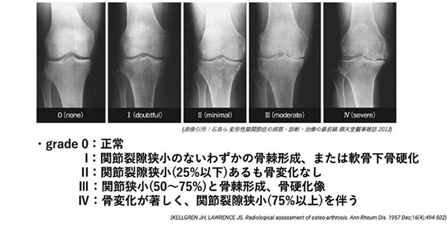 変形性膝関節症