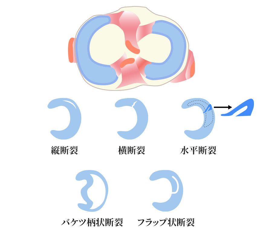 半月板損傷