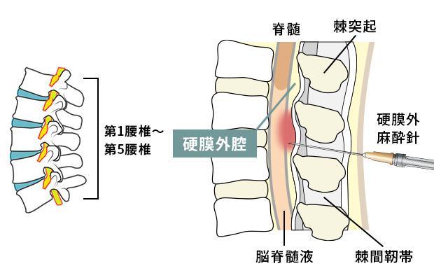 腰部硬膜外ブロック