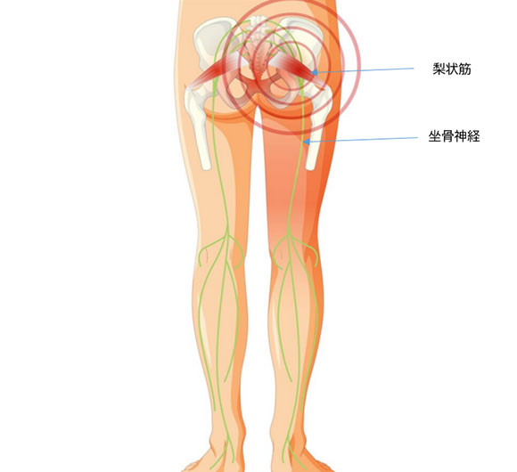 梨状筋症候群