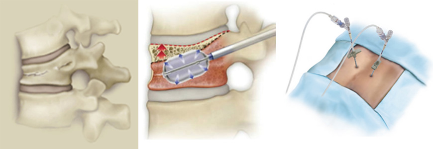 椎体骨折の治療について