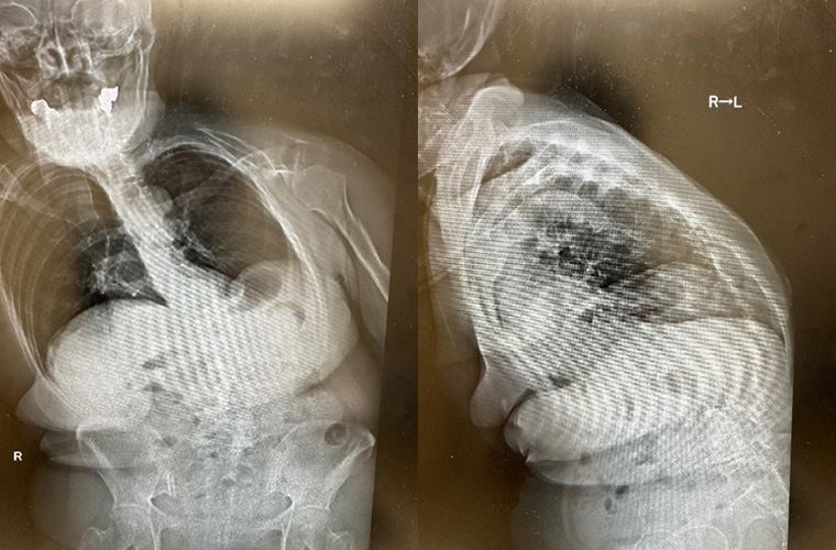 脊柱変形による背部痛・腰痛