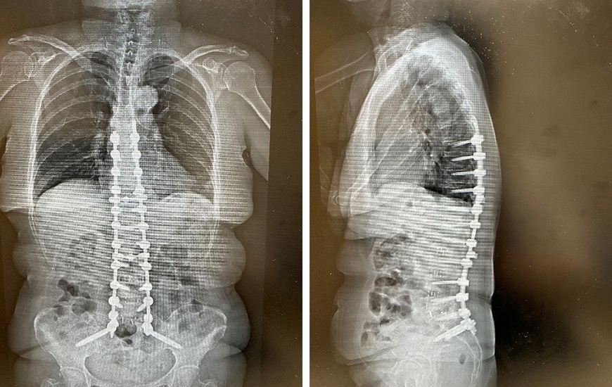 脊柱変形による背部痛・腰痛