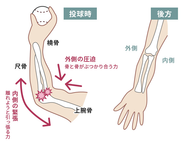 野球肘の原因
