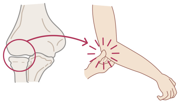 外側型の野球肘
