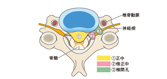 頸椎椎間板ヘルニアとは