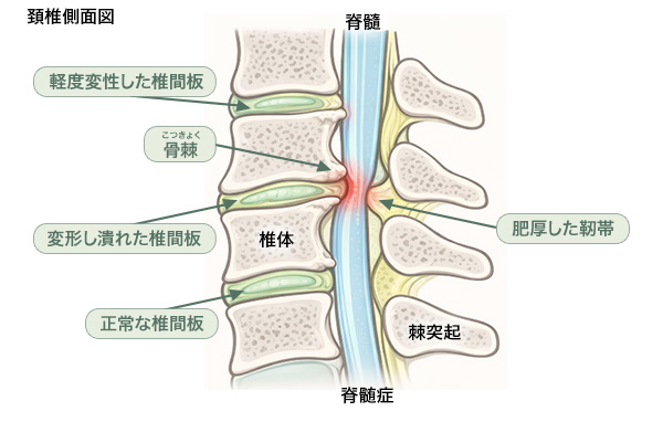 頚髄症
