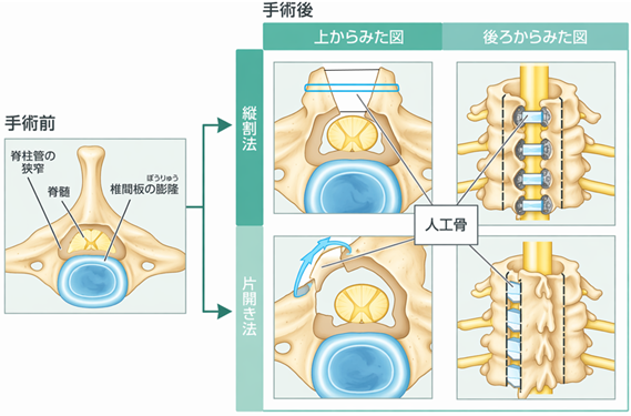 人工骨の場合