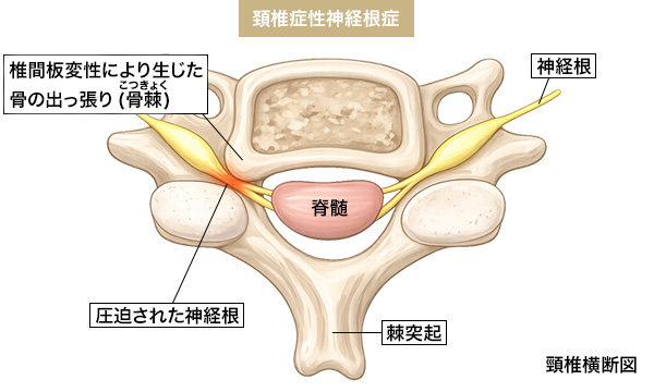 頸椎症性神経根症