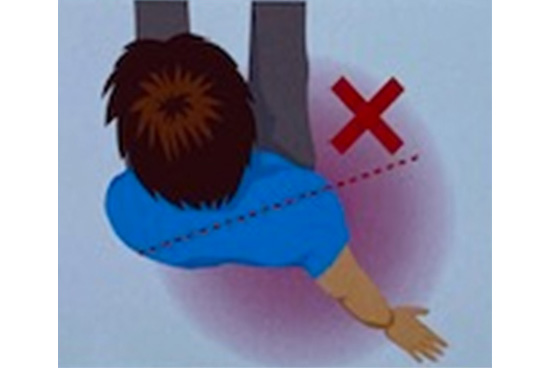 肩が脱臼する原因、仕組み