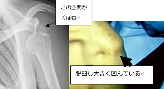 肩の脱臼の診断方法