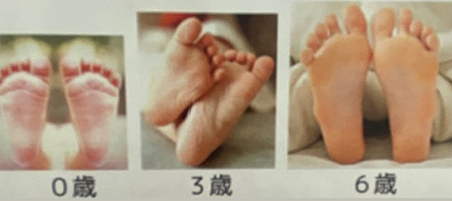 小学生の扁平足(小児期扁平足)