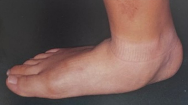 中学生・高校生の扁平足(思春期扁平足)