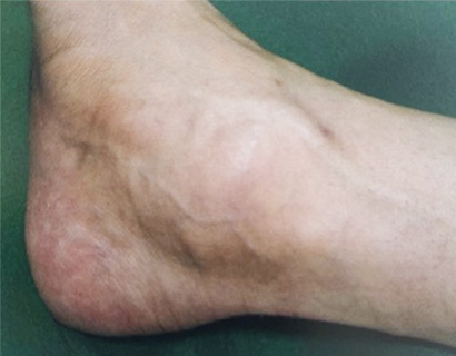 後脛骨筋機能不全とは