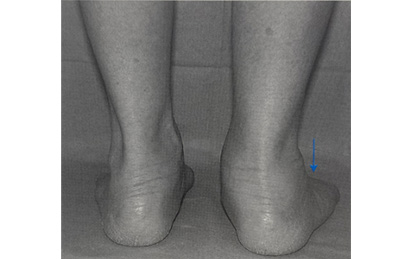 扁平足の診断・検査
