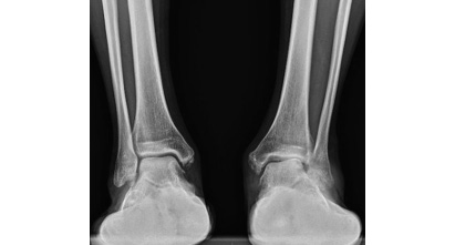扁平足の診断・検査
