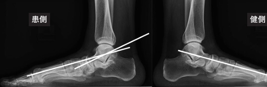 扁平足の診断・検査