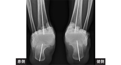 扁平足の診断・検査