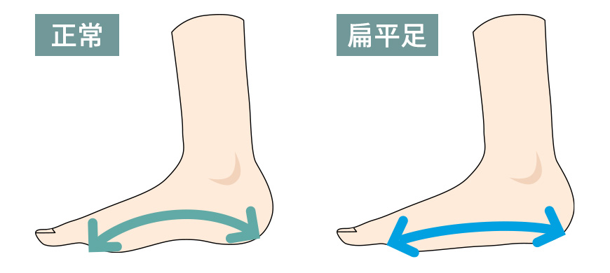 扁平足_開帳足