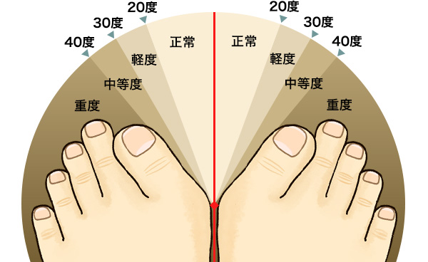 外反母趾の症状
