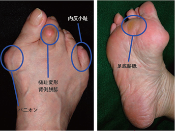 外反母趾の症状とは？