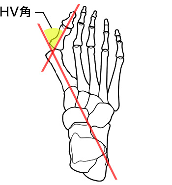 外反母趾の重症度による症状の違い