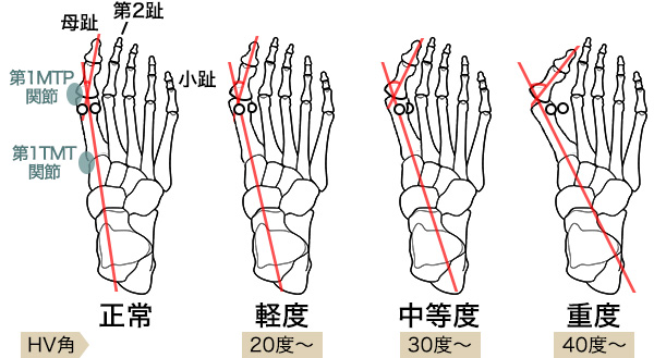 外反母趾の重症度による症状の違い