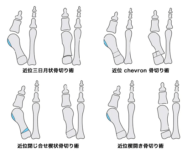 第一中足骨の骨切り術