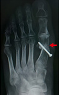 手術画像：日本足の外科学会