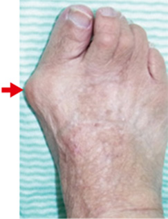 画像参照：日本足の外科学会