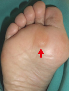 画像参照：日本足の外科学会