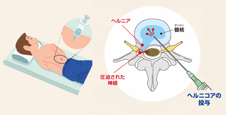 コンドリアーゼ（ヘルニコア）