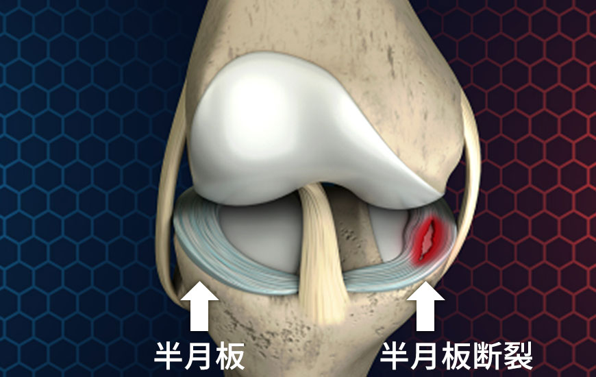 半月板の痛み