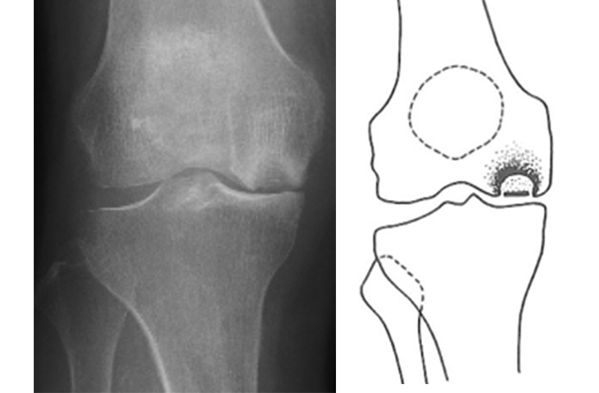 膝関節特発性骨壊死