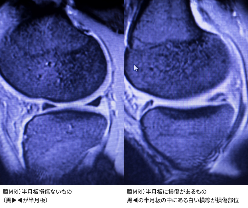 半月板損傷MRI写真