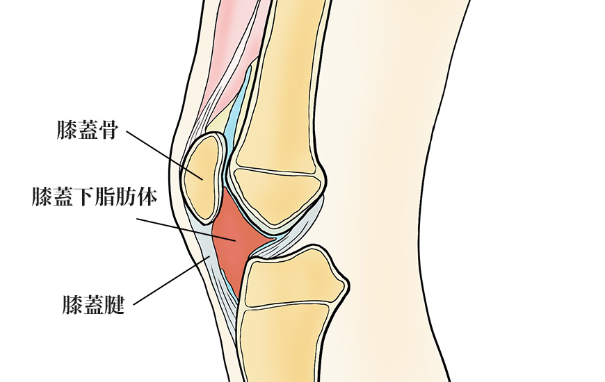 膝蓋下脂肪体炎