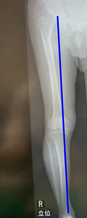 足底装具することで荷重線を外し、膝の負担を減らす装具療法