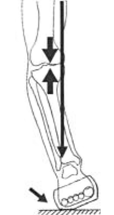 足底装具することで荷重線を外し、膝の負担を減らす装具療法