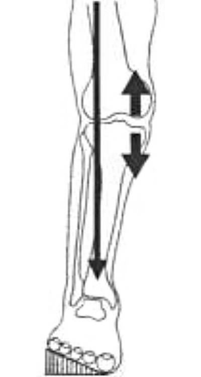 足底装具することで荷重線を外し、膝の負担を減らす装具療法