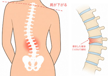脊椎変形による腰痛