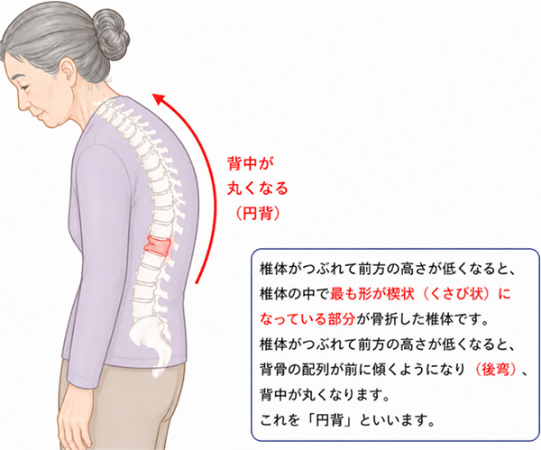 背中が丸くなる（円背）