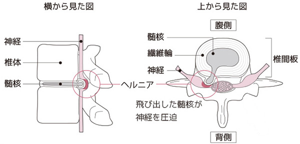 腰椎椎間板ヘルニアの病態