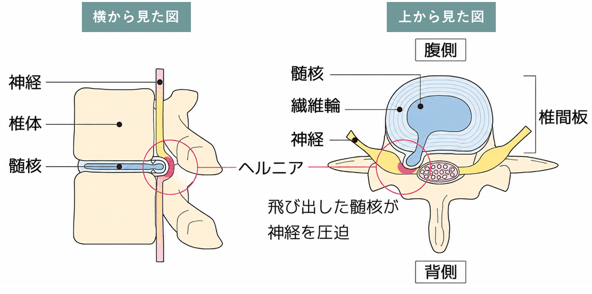 腰椎椎間板ヘルニアの病態