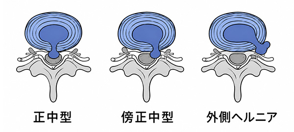 腰椎椎間板ヘルニア_程度