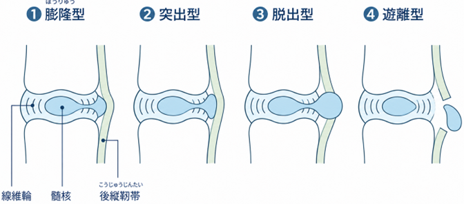 腰椎椎間板ヘルニア_種類