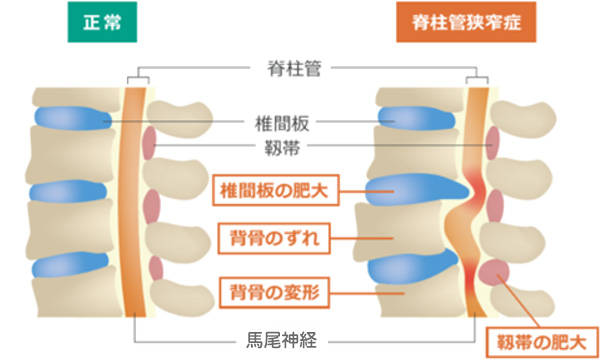 腰部脊柱管狭窄症
