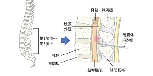 硬膜外ブロック