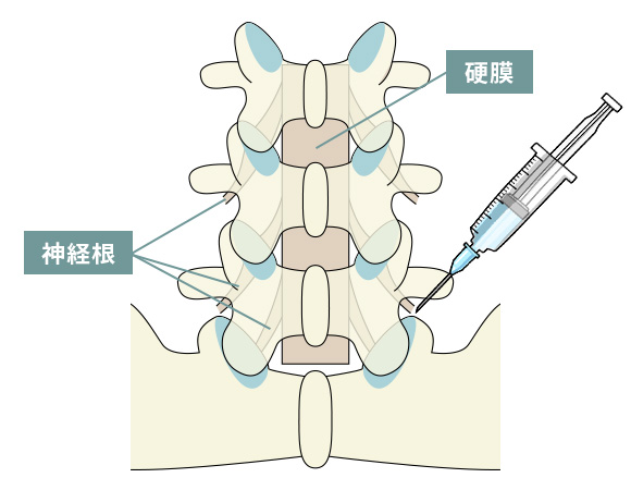 神経根ブロック